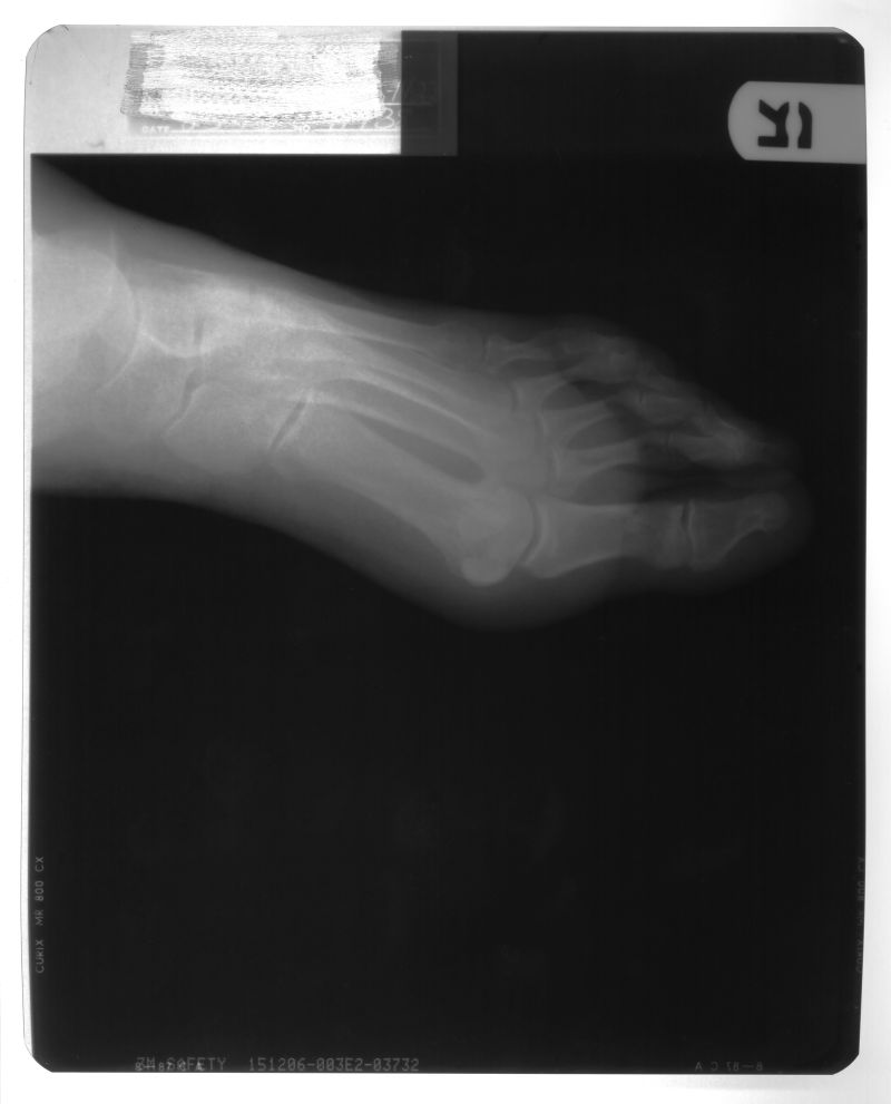 脚掌部位骨骼x射线片子