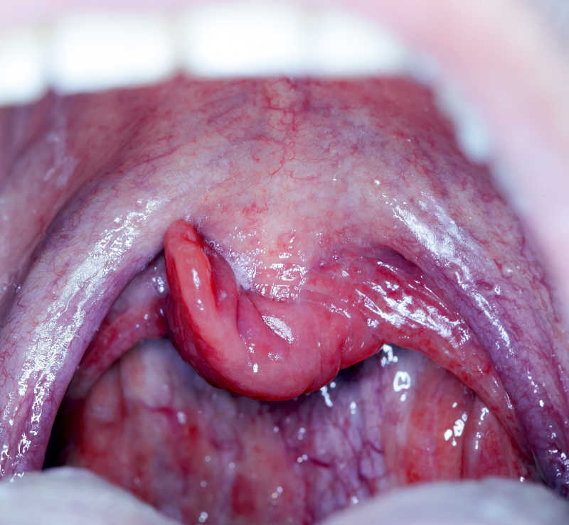 咽喉扁桃体发炎