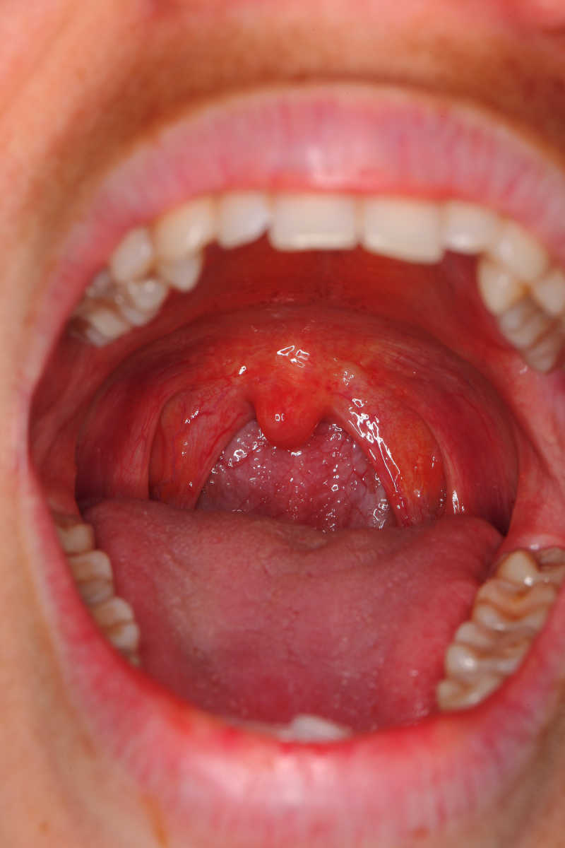 喉咙发炎图 正常图片