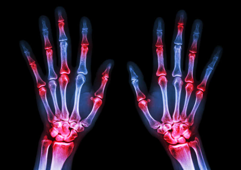 X射线下的手图片 X光片手和多关节炎素材 高清图片 摄影照片 寻图免费打包下载