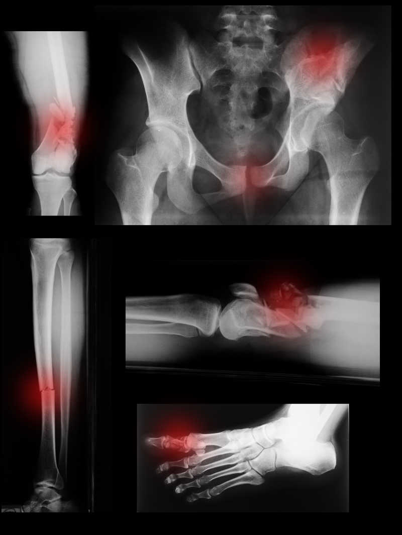 X射线下的腿骨和脚骨