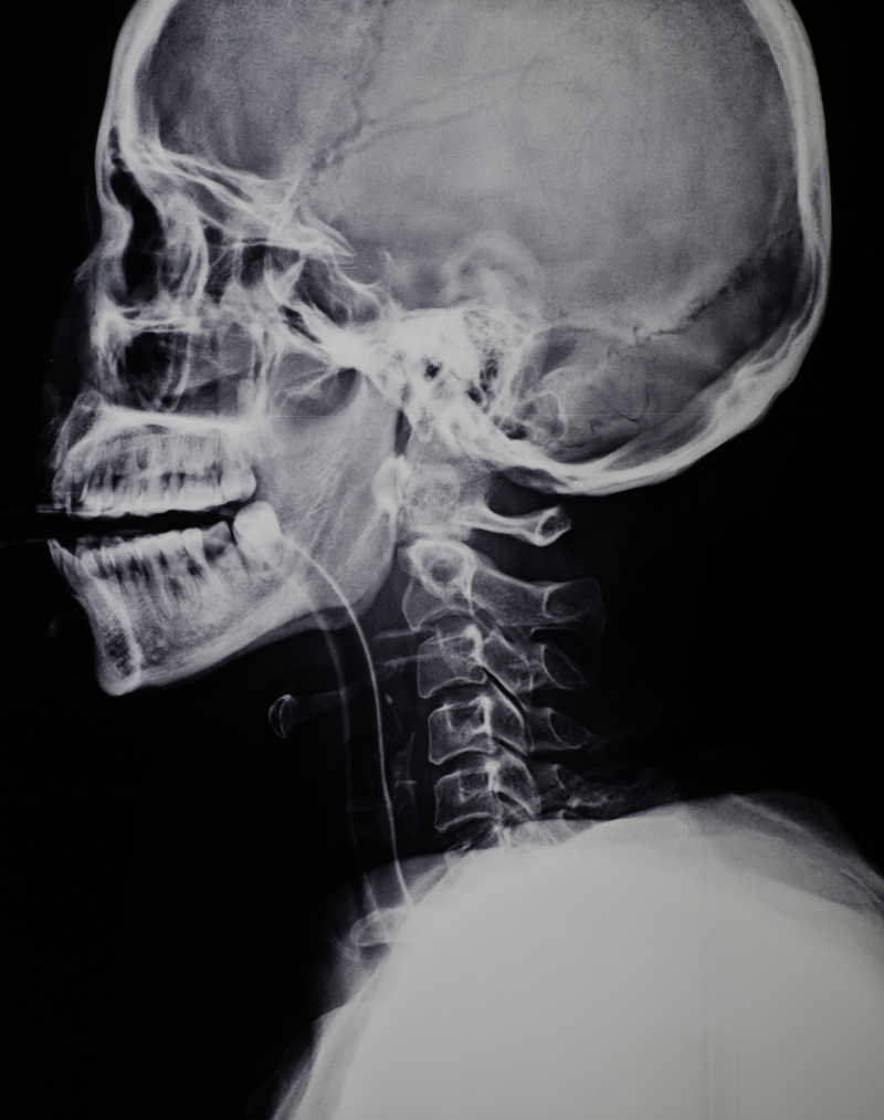 X射线的脖子