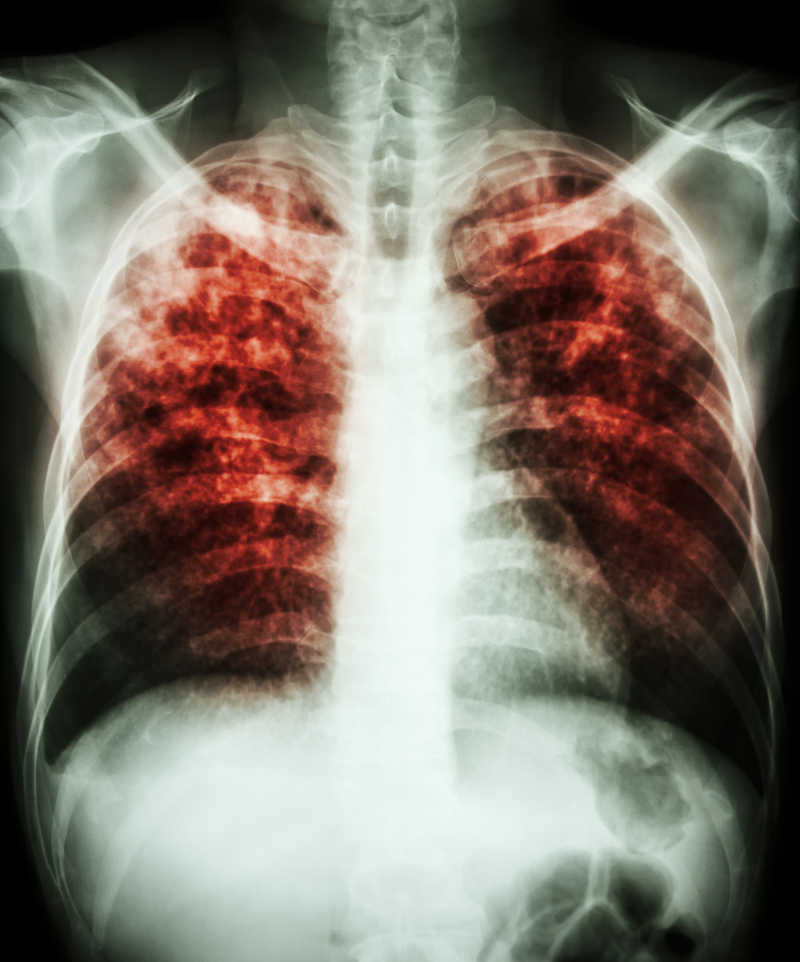 肺结核x线胸片图片 X线胸片显示结核分枝杆菌感染引起的肺间质浸润素材 高清图片 摄影照片 寻图免费打包下载