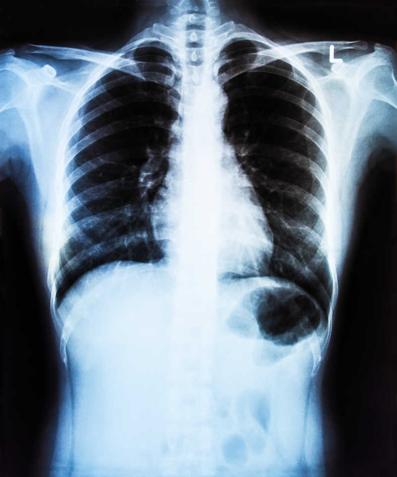 医学诊断的人胸部x线影像