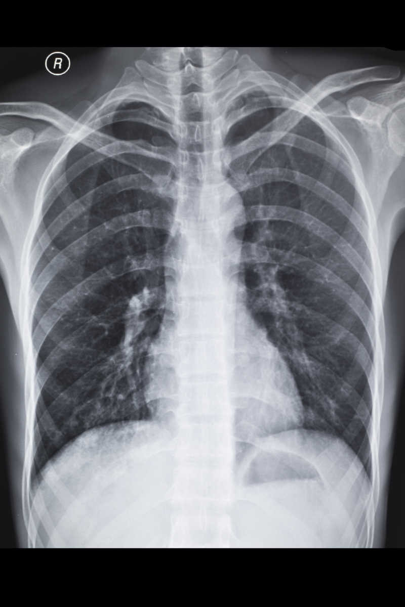 肺部阴影x光片图片
