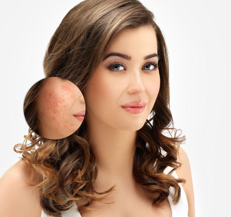 美女脸部痤疮治疗效果图