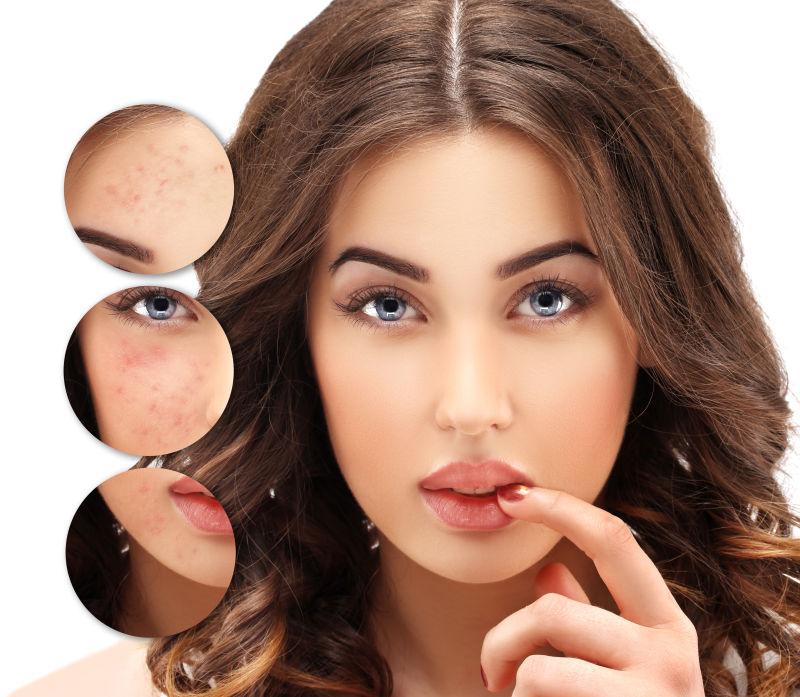 女人痤疮治疗前后的对比图