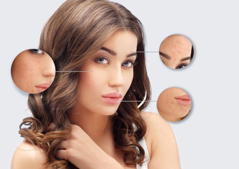 金发美女的痤疮治疗前后对比图