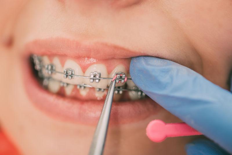 牙医正在检查牙套上的托槽