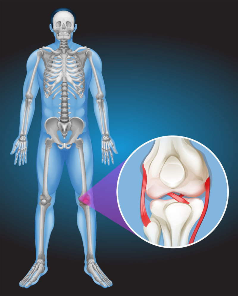 抽象矢量人体膝关节疼痛的图解