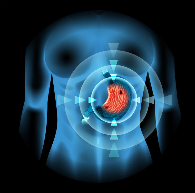 抽象矢量妇女胃溃疡插图