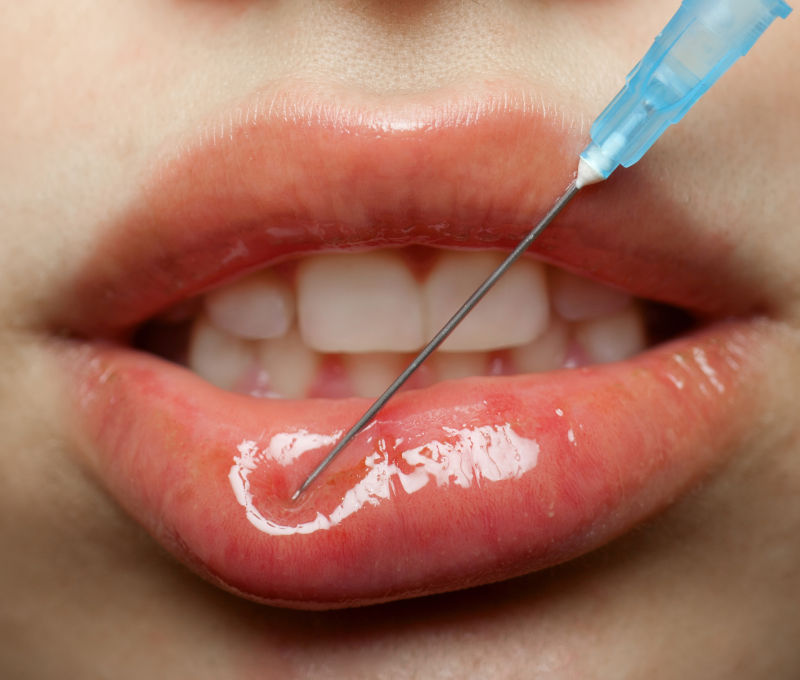 肉毒毒素注射嘴唇