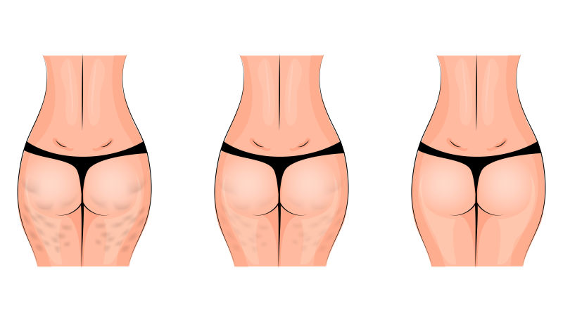 臀部前后脂肪组织图解