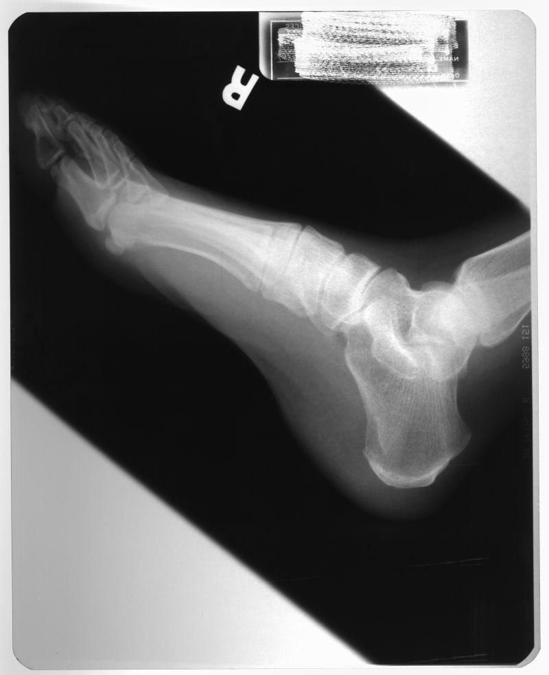 人体脚掌部骨骼x射线片子