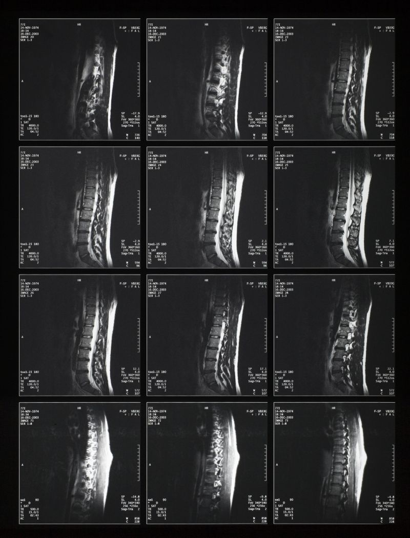 人体脊椎x射线片子
