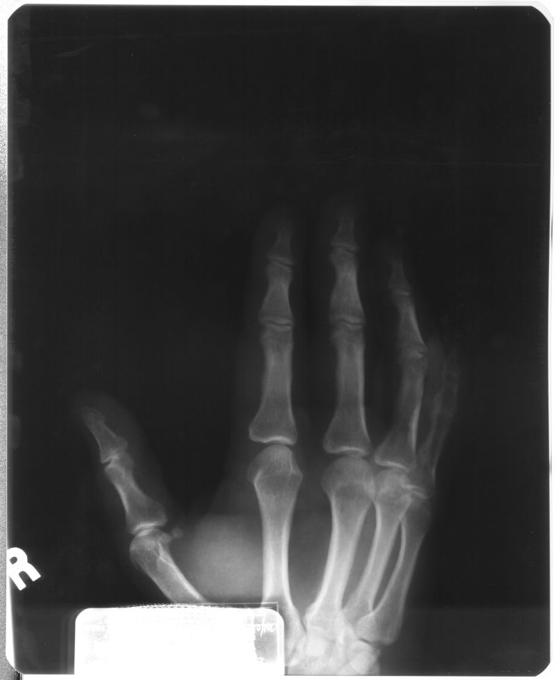 人体手掌x射线片子