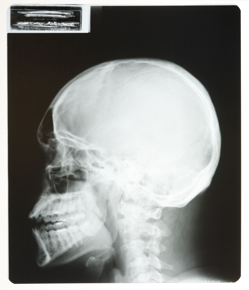 人体头部骨骼x射线片子