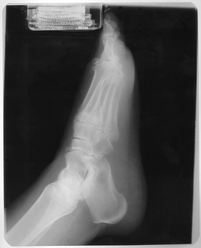 人体脚掌侧面x射线片子
