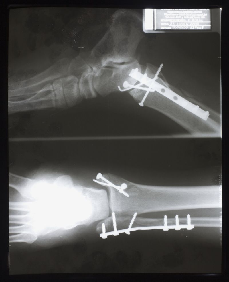 人体的脚骨骨骼x射线片子