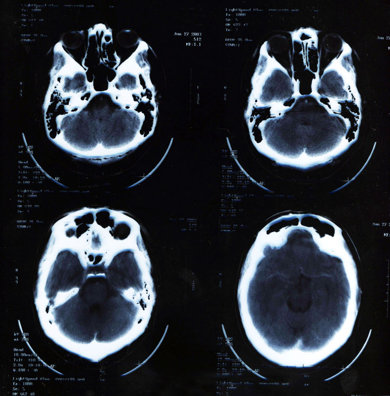人体大脑x射线片子