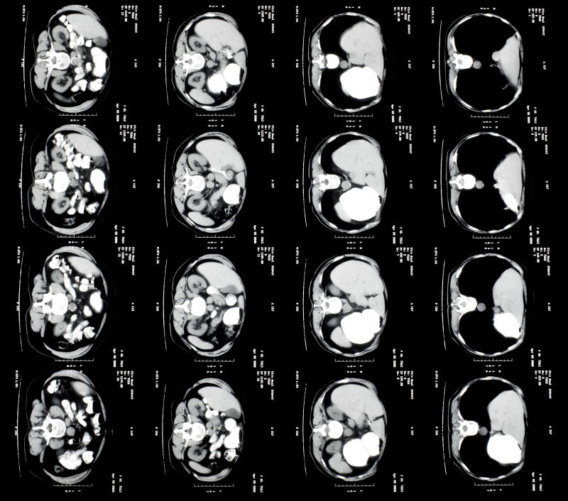 患者的CT扫描图