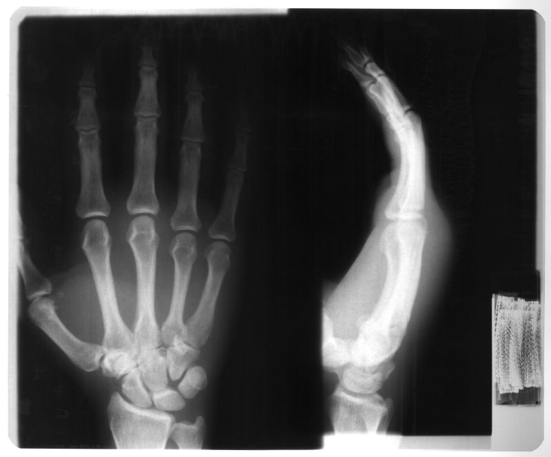 人体手部x射线片子