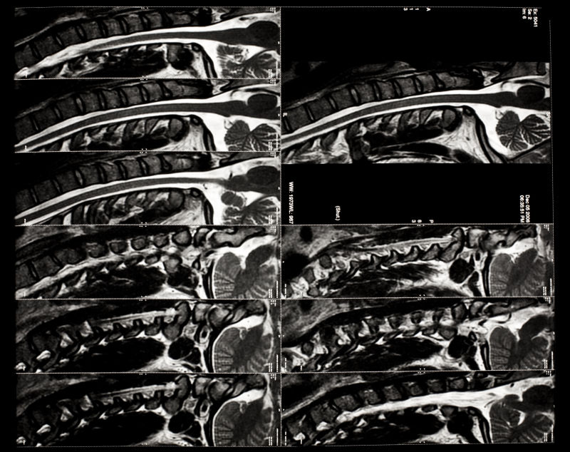 人体脊椎各角度x射线片子