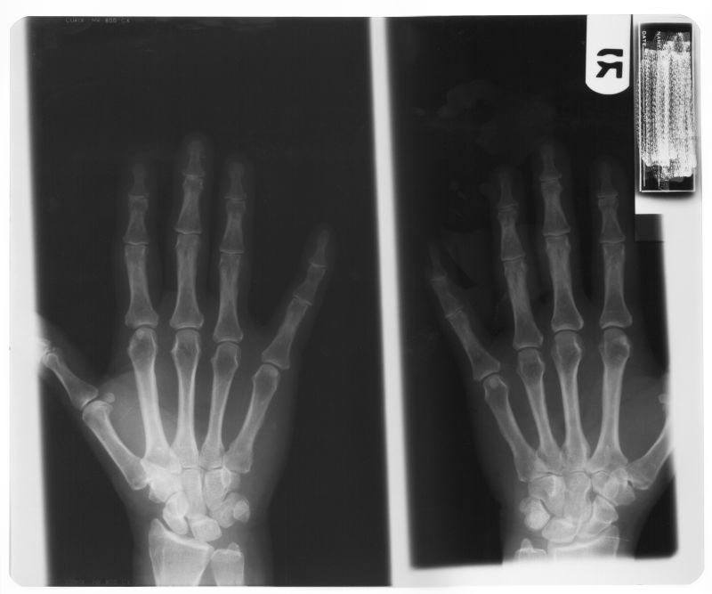 人体手掌正面和背面x射线片子