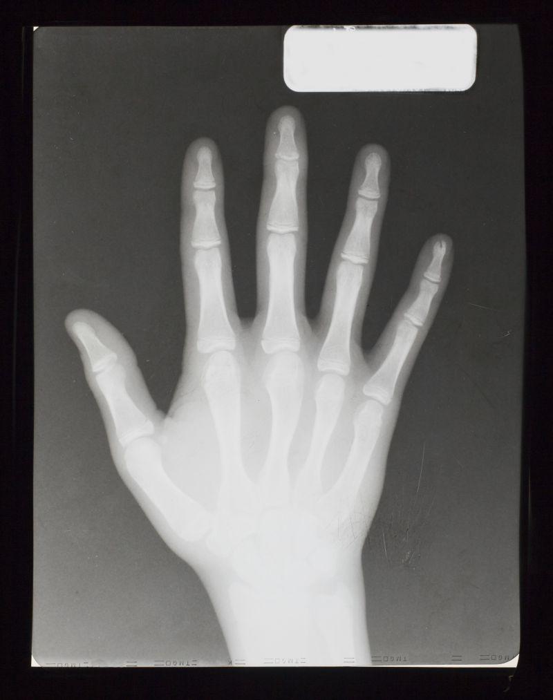 手掌骨骼结构图 x光片图片