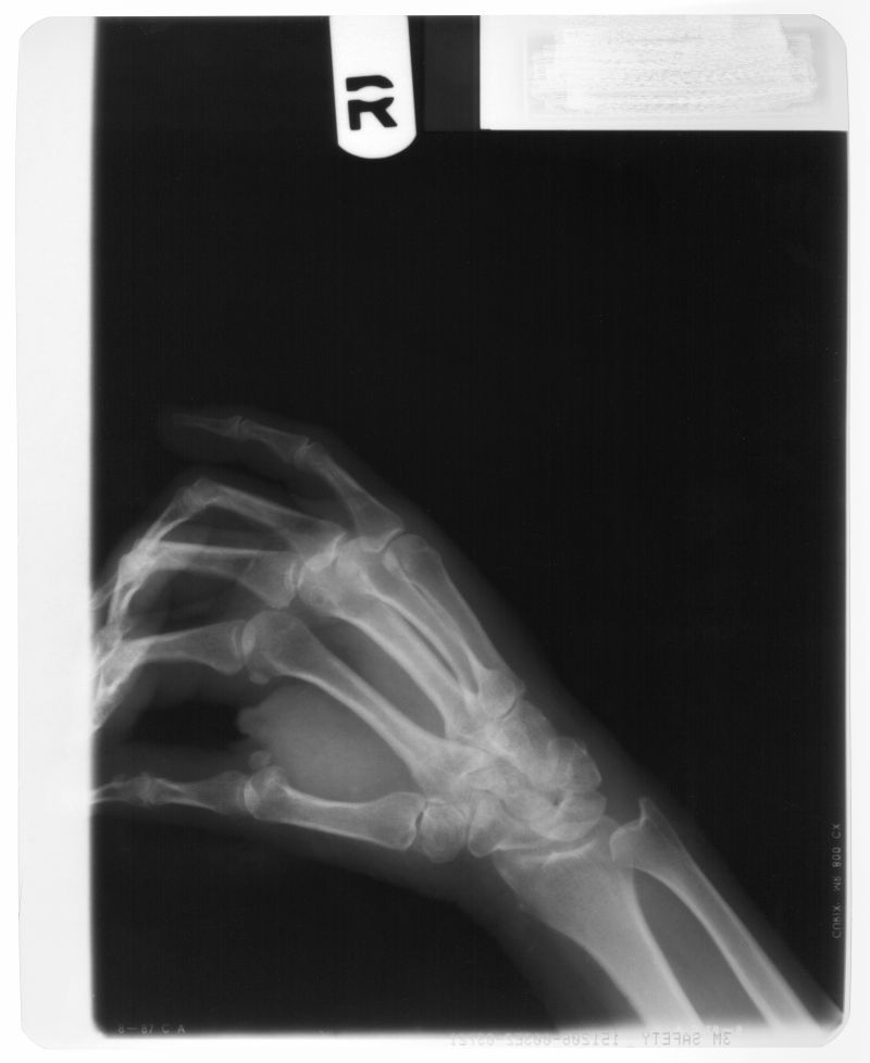 人的手掌骨x射线片子