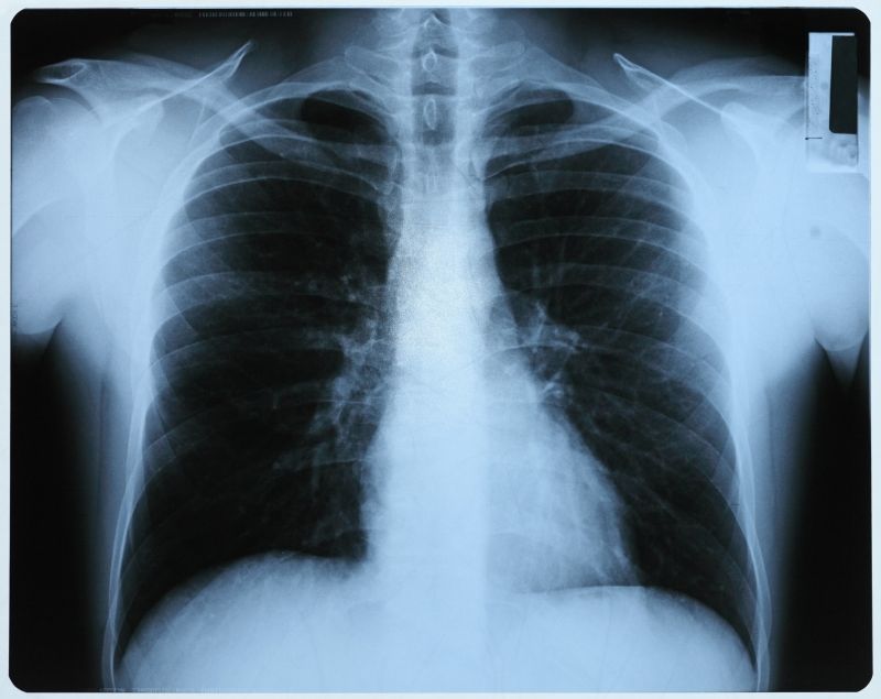 人体肺部x射线