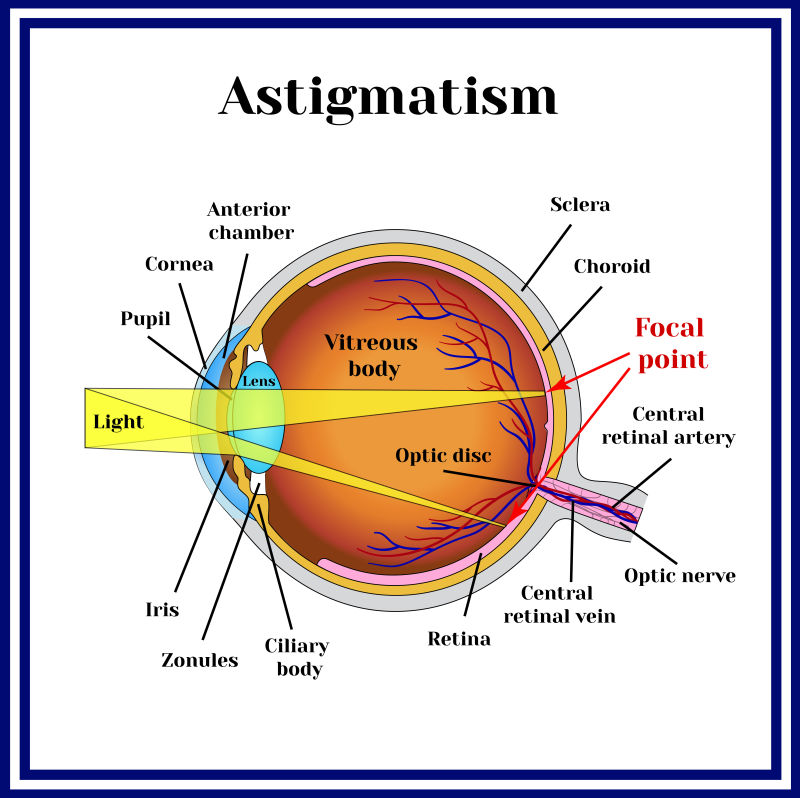 抽象矢量眼球反射错误主题的信息插图