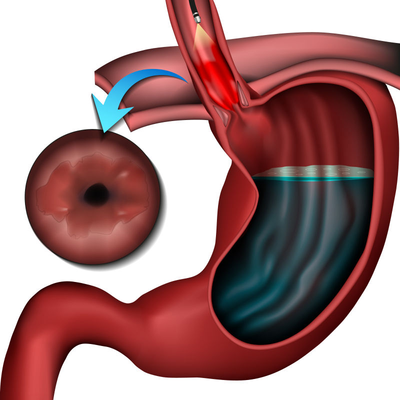 白底巴雷特食道疾病医学载体图