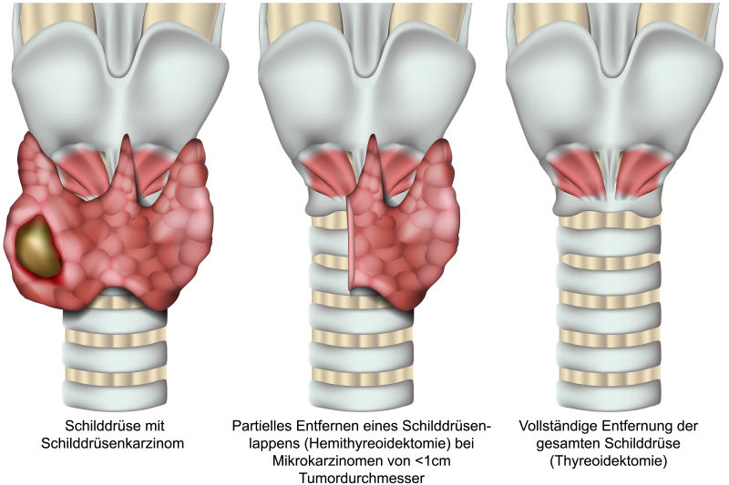 甲状腺切除术甲状腺三维医学向量图白底