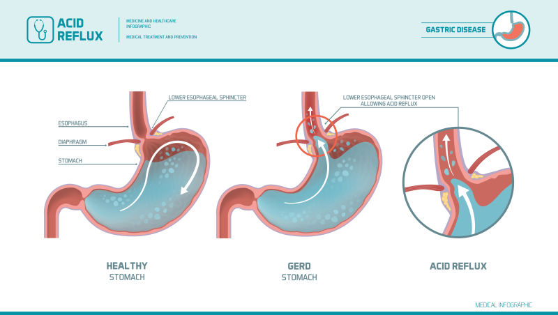 抽象现代胃酸反流主题的平面插图设计