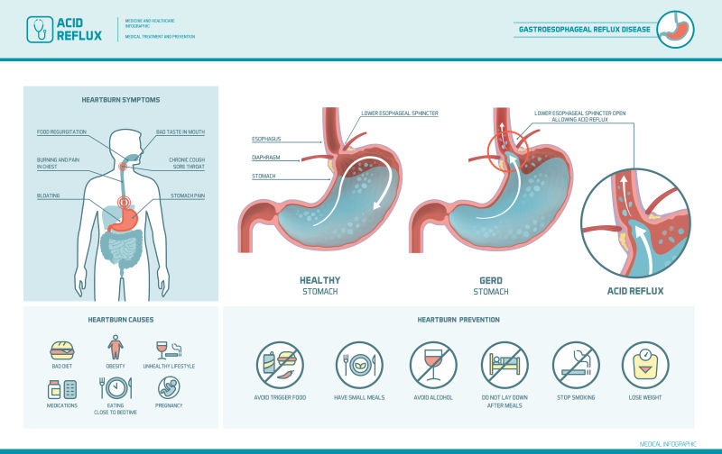 创意矢量胃酸反流主题的医学图解插图设计