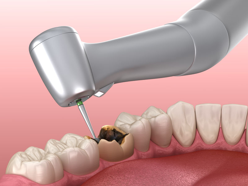 龋齿去除过程医学上精确的牙齿三维图