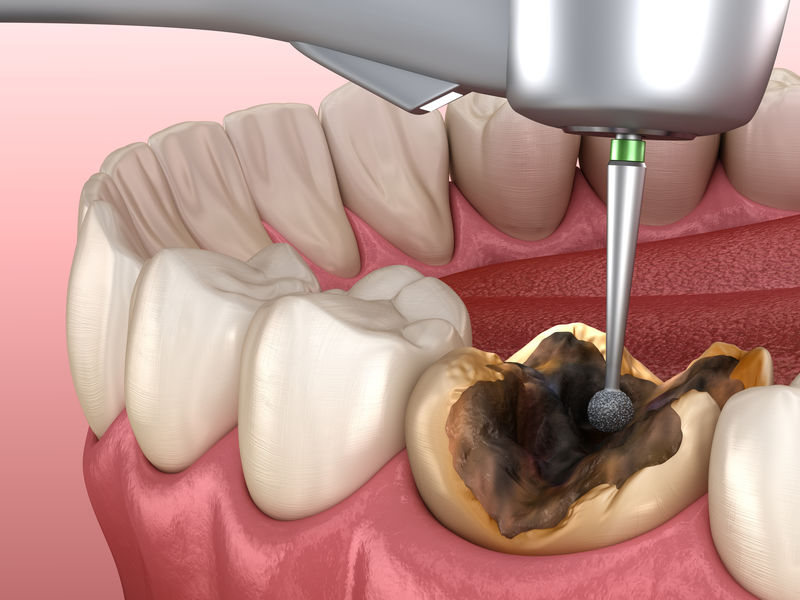 龋齿去除过程医学上精确的牙齿三维图