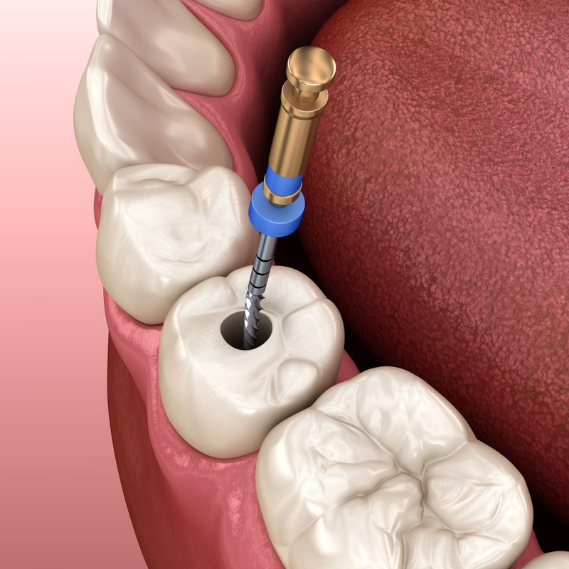 根管治疗过程医学上精确的牙齿三维图