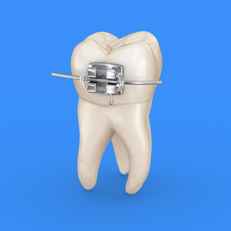 牙齿和金属支架三维图解概念