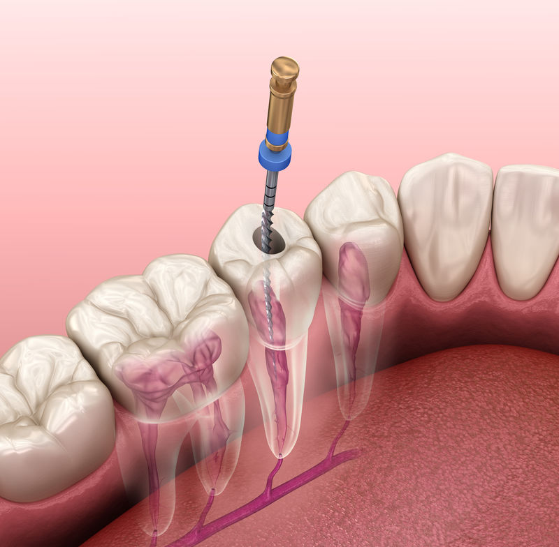 根管治疗过程医学上精确的牙齿三维图