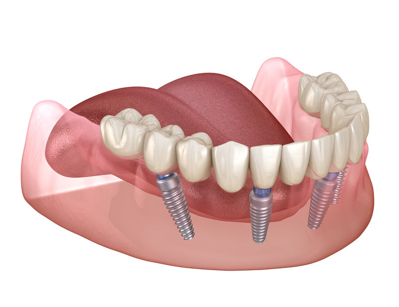 下颌骨假体全部在4个系统上由种植体支撑医学上精确的三维人体牙齿和假牙概念图