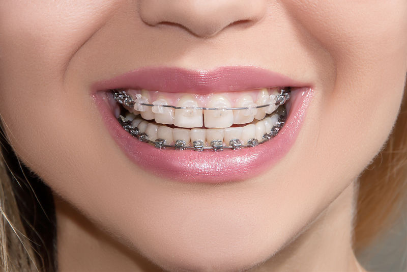 在牙齿上贴上陶瓷和金属支架-宽广的微笑-自缚的括号-正畸治疗-微笑着露出牙套的女人