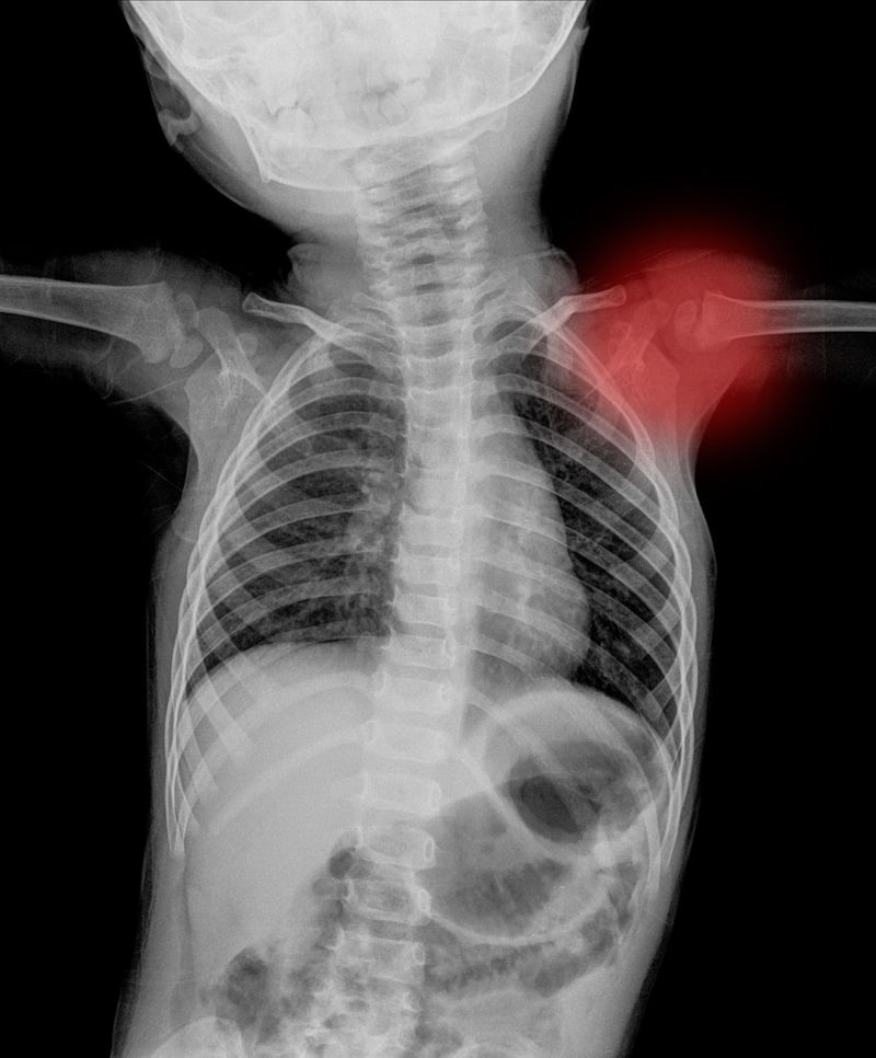 X射线下的身体骨骼