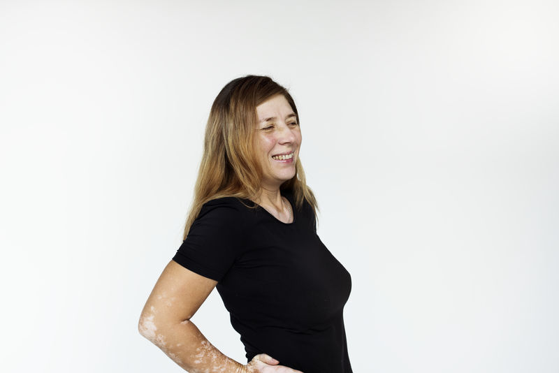 有皮肤病的女人的画像