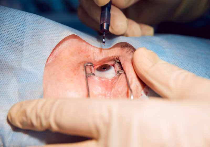 儿童眼睛动手术图片图片
